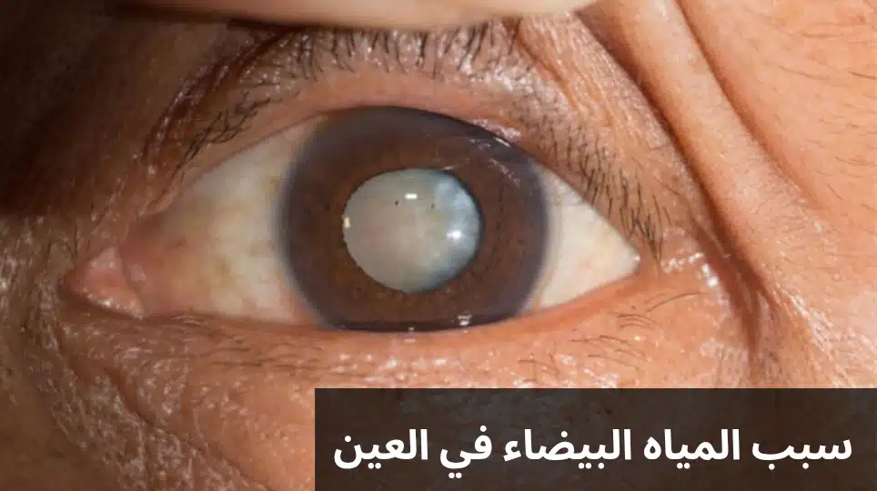 1000291348 1 سبب المياه البيضاء في العين