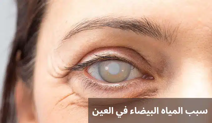 1000291349 سبب المياه البيضاء في العين
