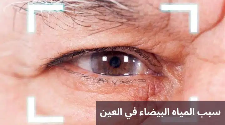 سبب المياه البيضاء في العين
