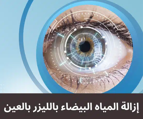 إزالة المياه البيضاء بالليزر بالعين