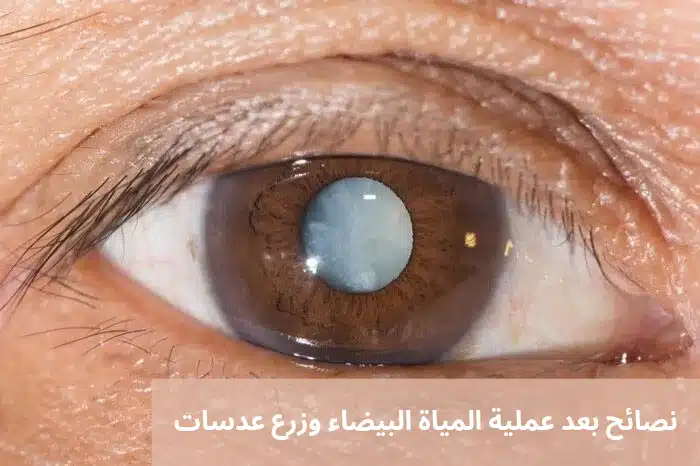 1000292056 نصائح بعد عملية المياة البيضاء وزرع عدسات