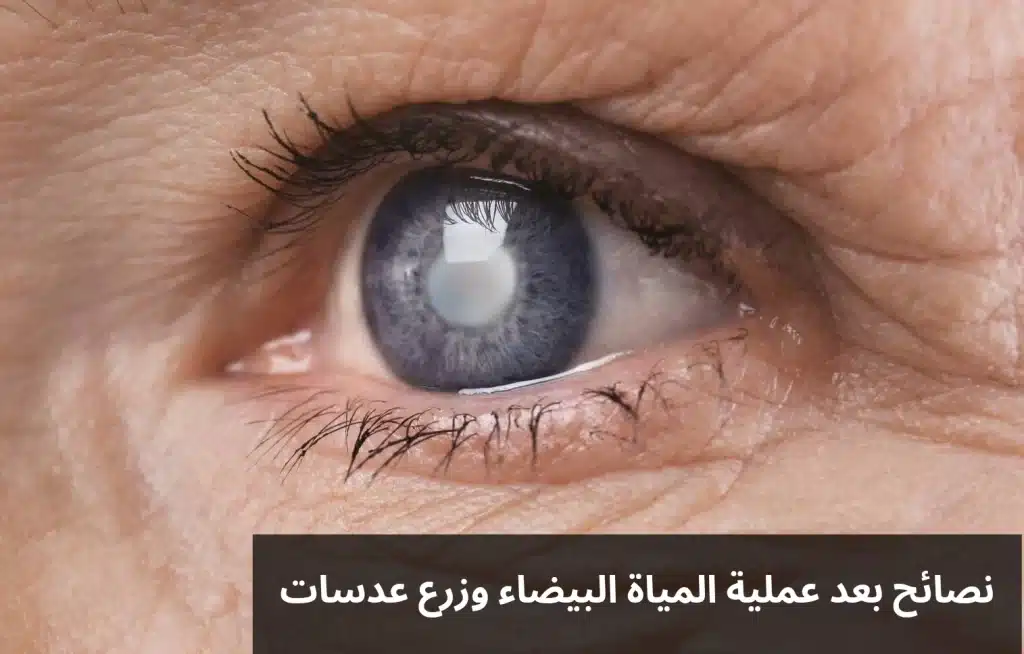 1000292057 نصائح بعد عملية المياة البيضاء وزرع عدسات