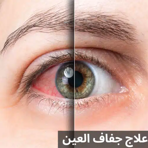علاج جفاف العين