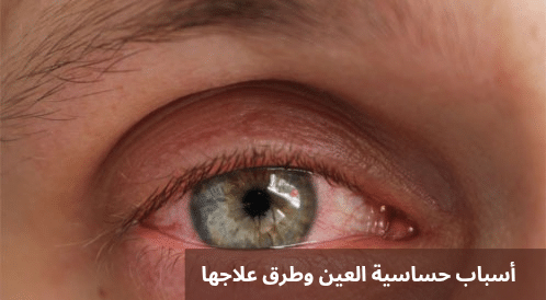 1000296906 أسباب حساسية العين وطرق علاجها