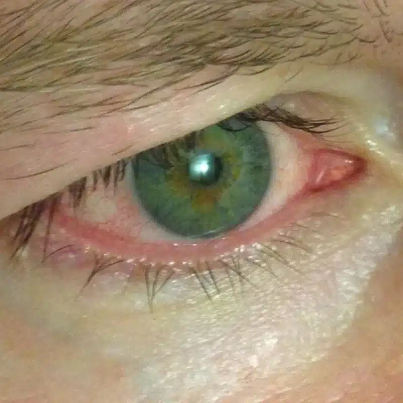 أسباب حساسية العين وطرق علاجها