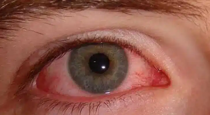 1000296908 أسباب حساسية العين وطرق علاجها