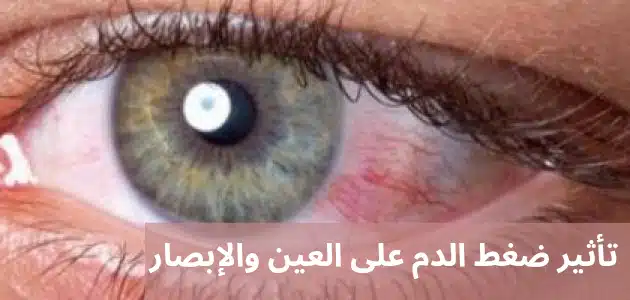 1000298423 تأثير ضغط الدم على العين والإبصار