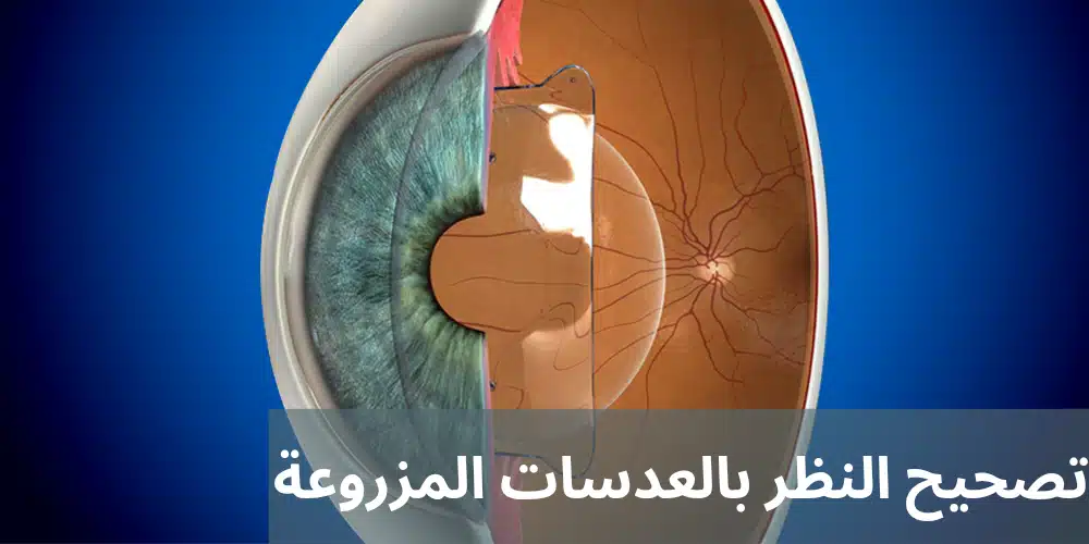 تصحيح النظر بالعدسات المزروعة