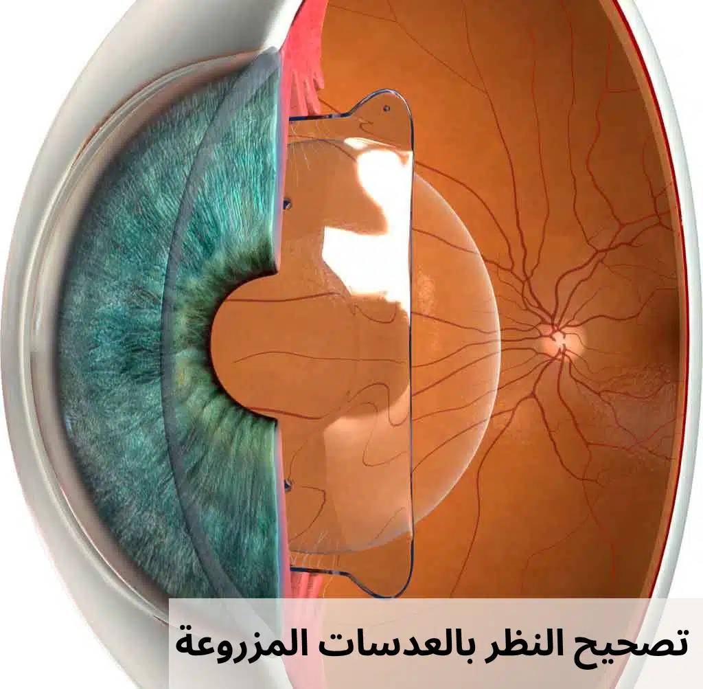 1000299317 تصحيح النظر بالعدسات المزروعة