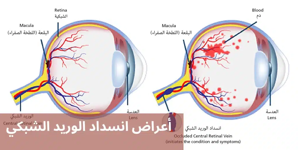 1000299997 أعراض انسداد الوريد الشبكي