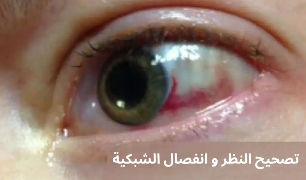 تصحيح النظر و انفصال الشبكية
