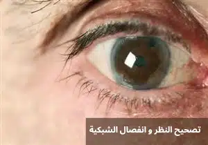 1000300587 تصحيح النظر و انفصال الشبكية