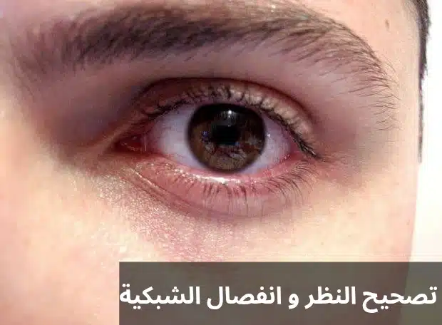 1000300588 تصحيح النظر و انفصال الشبكية