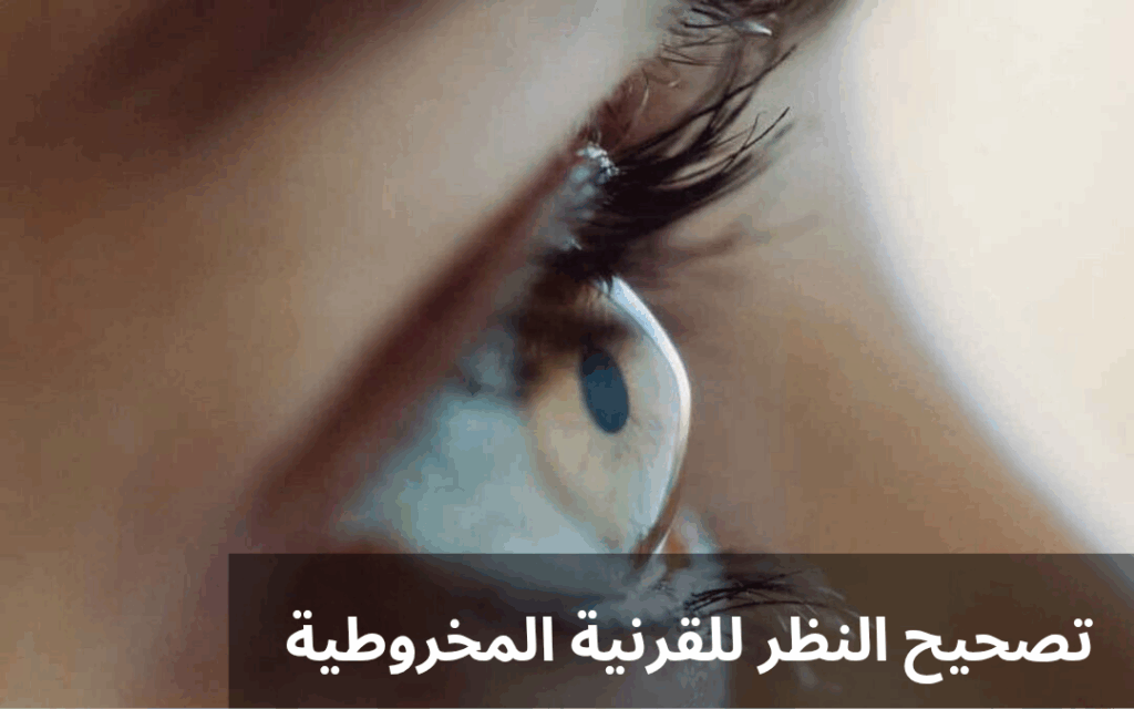 تصحيح النظر للقرنية المخروطية
