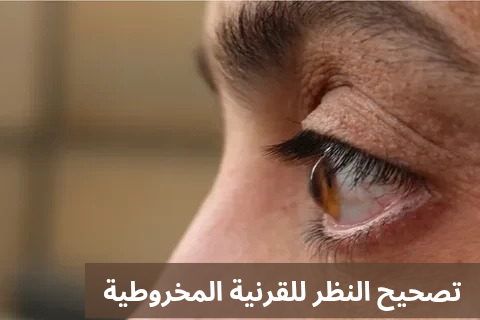 1000302008 تصحيح النظر للقرنية المخروطية