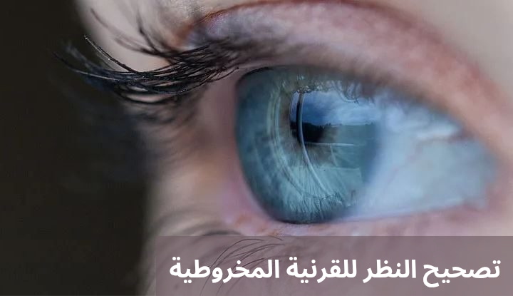 1000302058 تصحيح النظر للقرنية المخروطية