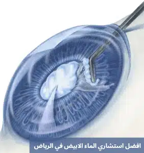 1000303233 افضل استشاري الماء الابيض في الرياض