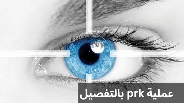 1000304724 عملية prk بالتفصيل
