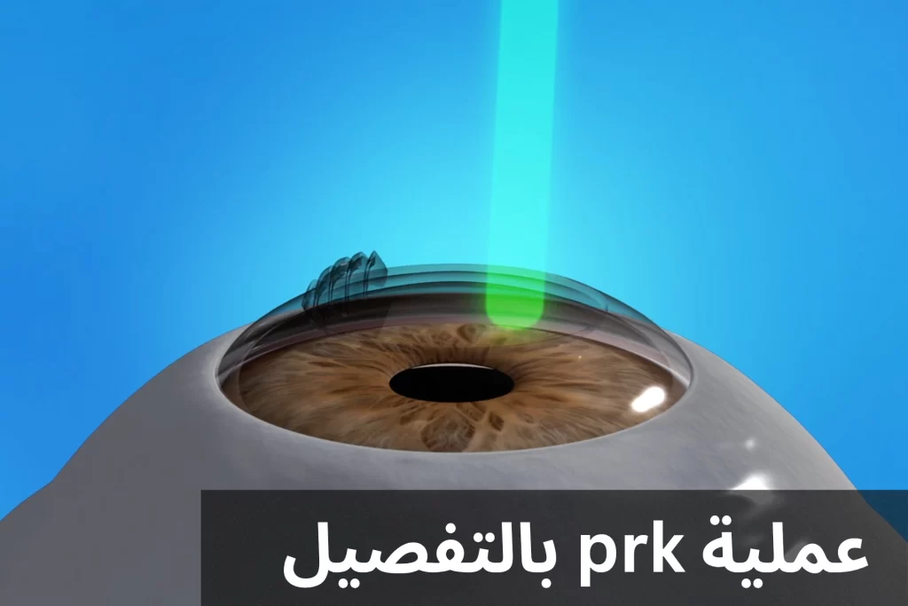 عملية prk بالتفصيل
