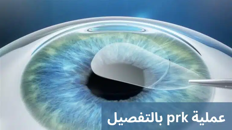 1000304726 عملية prk بالتفصيل