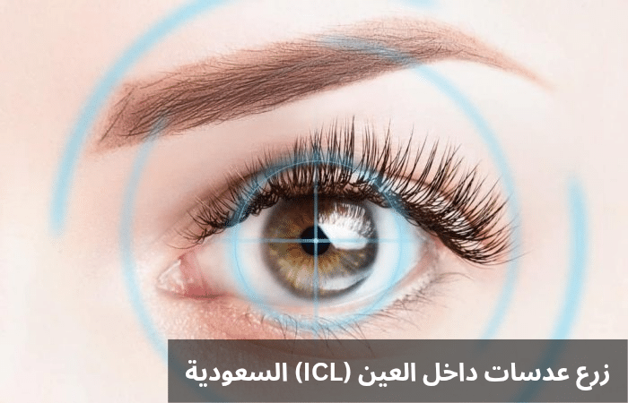 1000305270 زرع عدسات داخل العين ICL السعودية