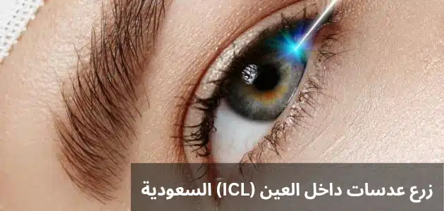 1000305272 زرع عدسات داخل العين ICL السعودية