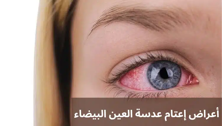 1000305488 أعراض إعتام عدسة العين البيضاء