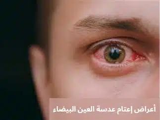 1000305489 أعراض إعتام عدسة العين البيضاء