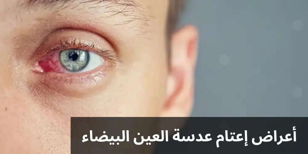 أعراض إعتام عدسة العين البيضاء