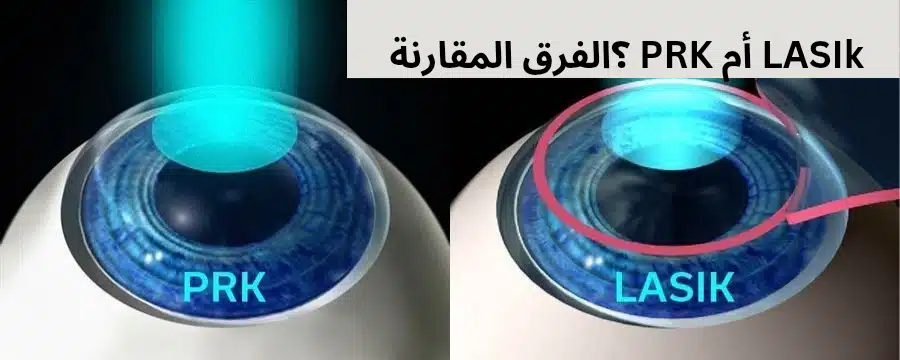 1000305586 LASIk أم PRK ؟الفرق المقارنة