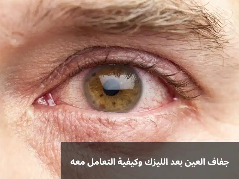 1000305645 جفاف العين بعد الليزك وكيفية التعامل معه