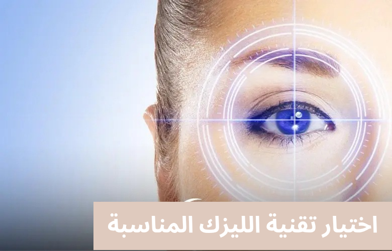 1000306092 اختيار تقنية الليزك المناسبة