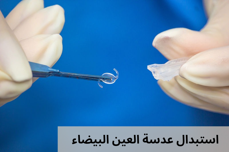 1000306206 استبدال عدسة العين البيضاء