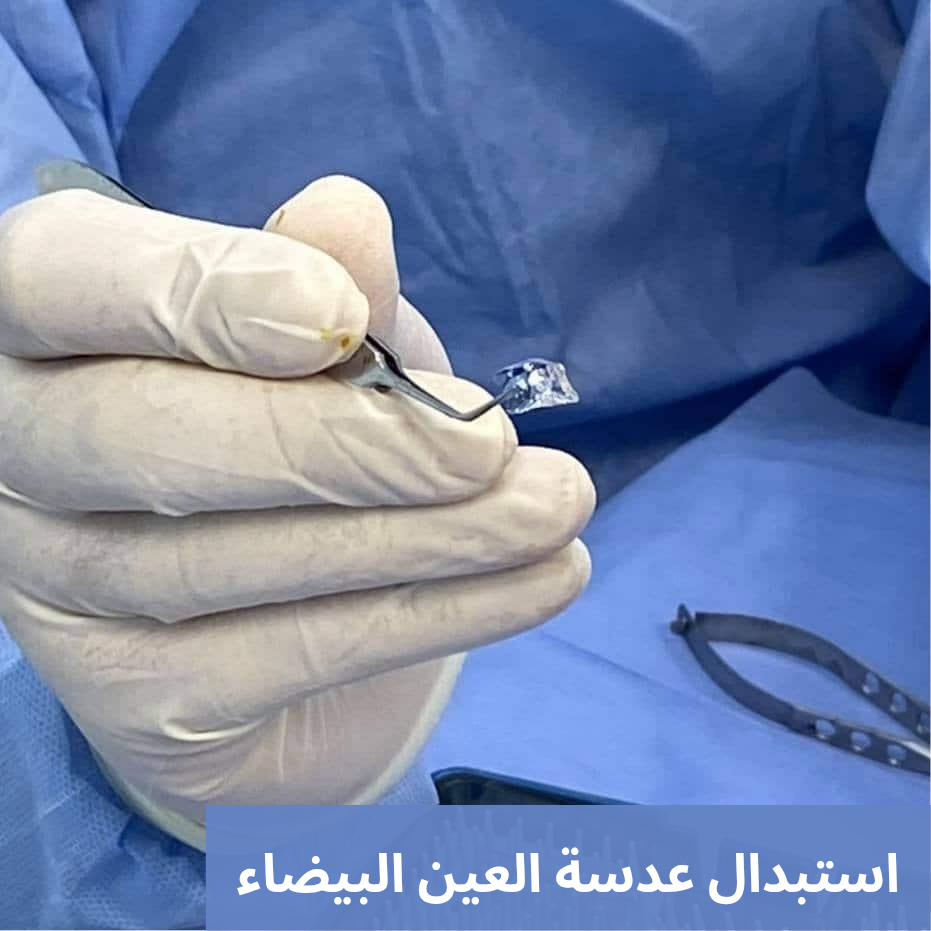 1000306207 استبدال عدسة العين البيضاء