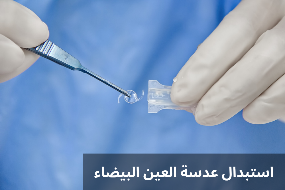 استبدال عدسة العين البيضاء

