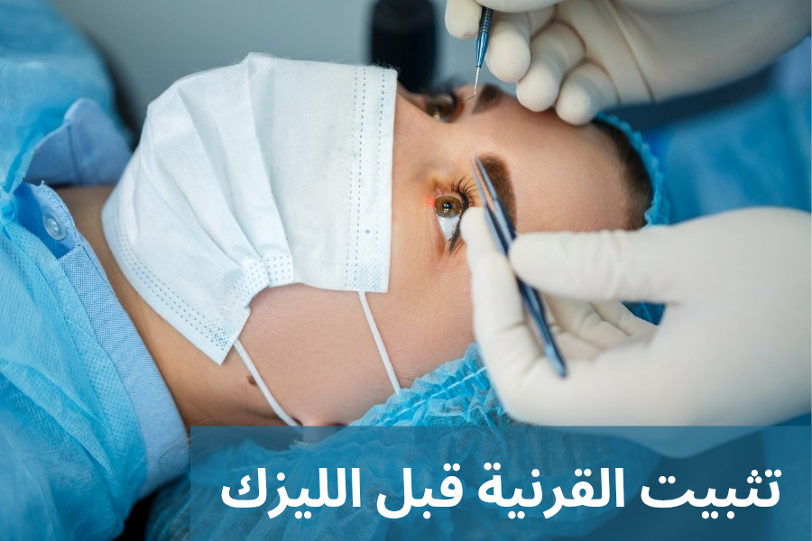 تثبيت القرنية قبل الليزك
