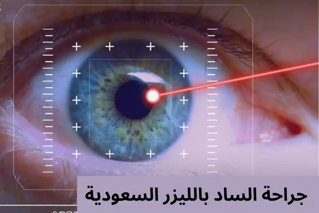 1000306637 جراحة الساد بالليزر السعودية