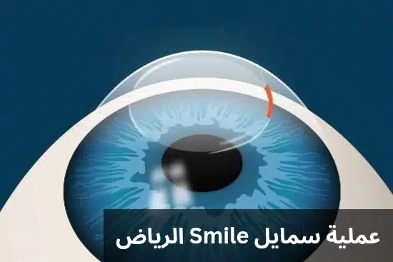 1000307377 عملية سمايل Smile الرياض