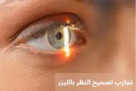 تجارب تصحيح النظر بالليزر
