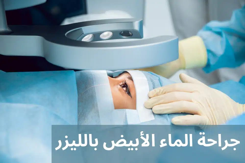 1000311269 جراحة الماء الأبيض بالليزر