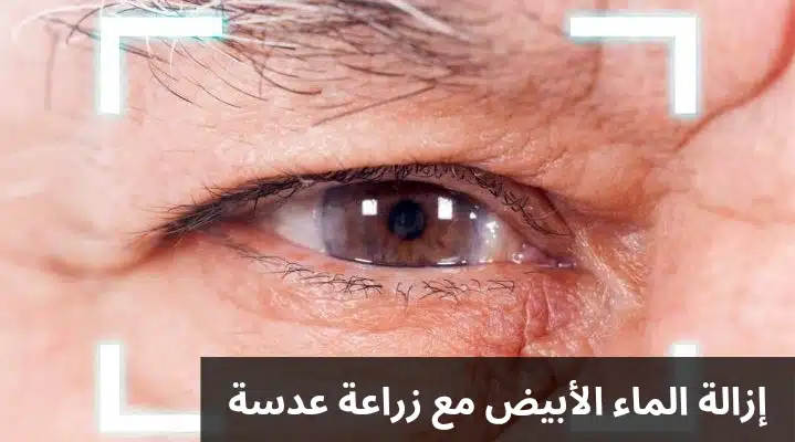 1000311456 إزالة الماء الأبيض مع زراعة عدسة