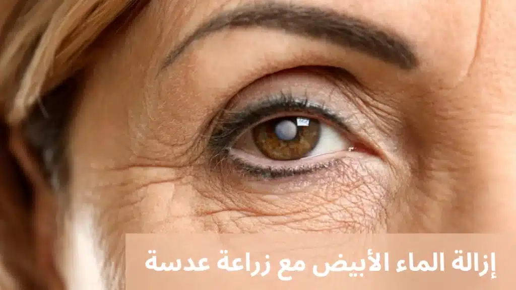 1000311457 إزالة الماء الأبيض مع زراعة عدسة