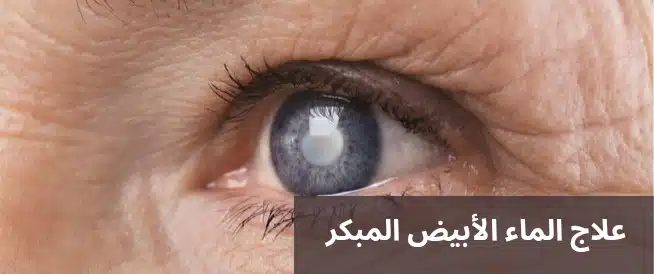 1000312484 علاج الماء الأبيض المبكر