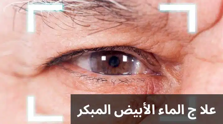 1000312485 علاج الماء الأبيض المبكر