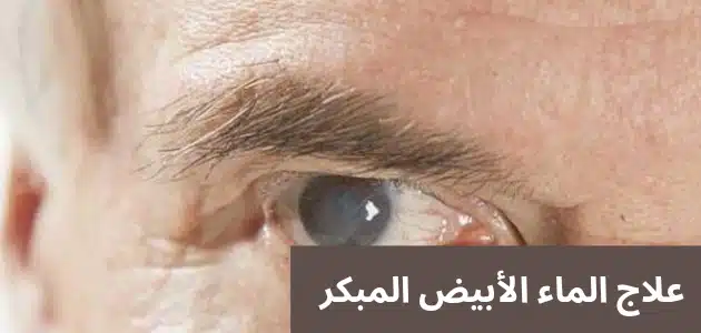 علاج الماء الأبيض المبكر