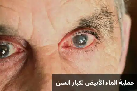 1000312962 عملية الماء الأبيض لكبار السن