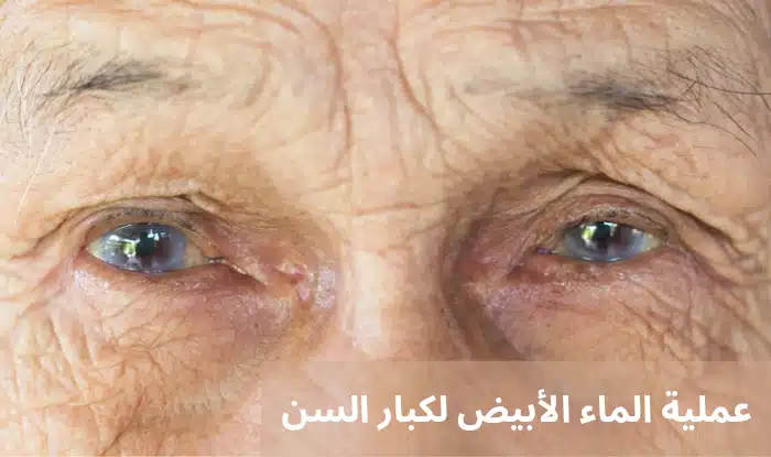 عملية الماء الأبيض لكبار السن

