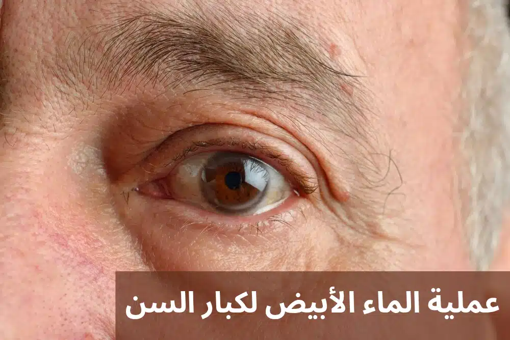 1000312964 عملية الماء الأبيض لكبار السن