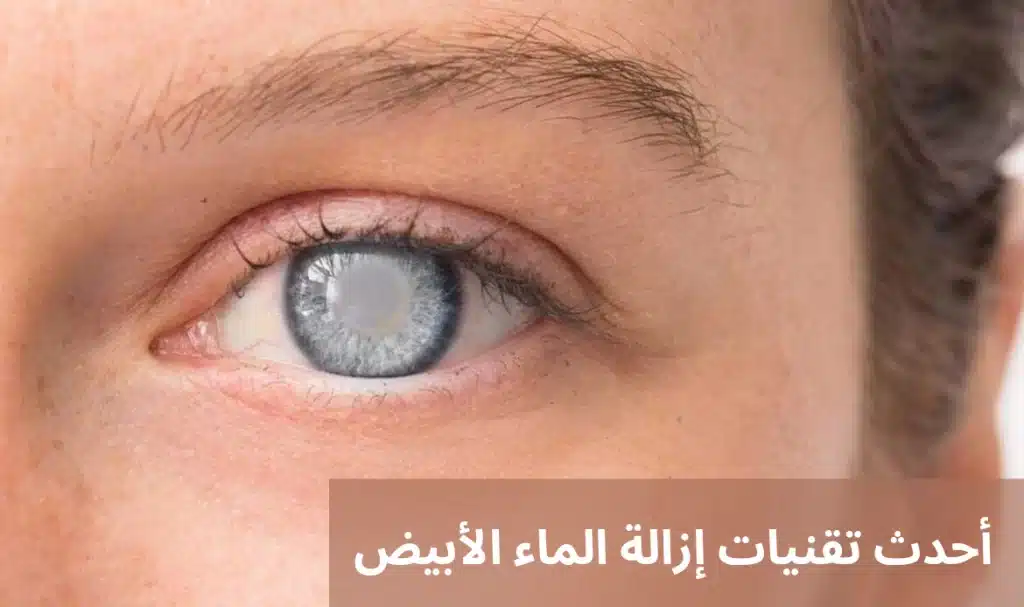 1000313861 أحدث تقنيات إزالة الماء الأبيض