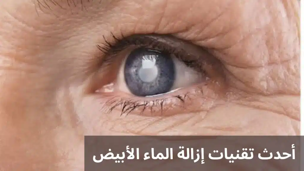 1000313862 أحدث تقنيات إزالة الماء الأبيض